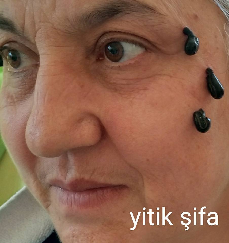 YİTİK ŞİFA HACAMAT Karamanda Hacamat Yapanlar